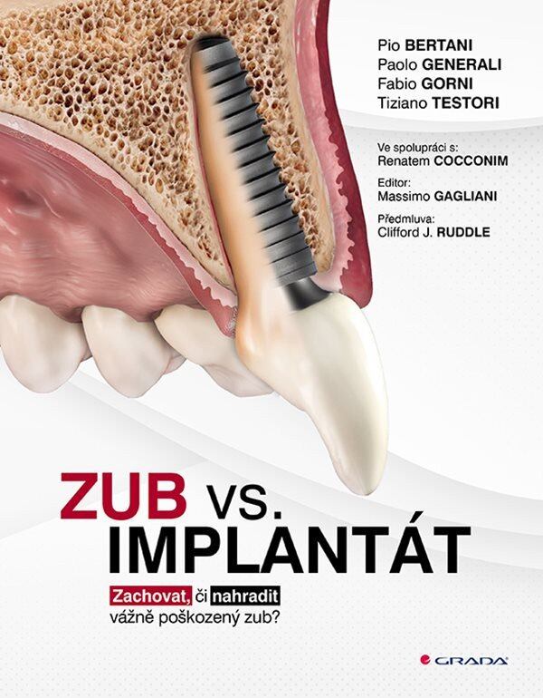 Levně Zub vs. implantát - Zachovat, či nahradit vážně poškozený zub?